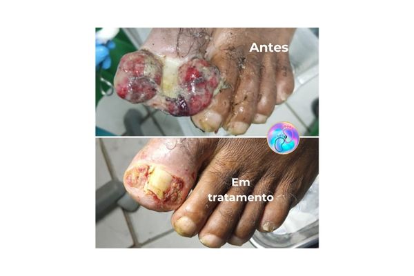 antes e depopis 21